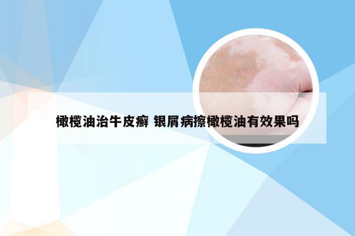 橄榄油治牛皮癣 银屑病擦橄榄油有效果吗