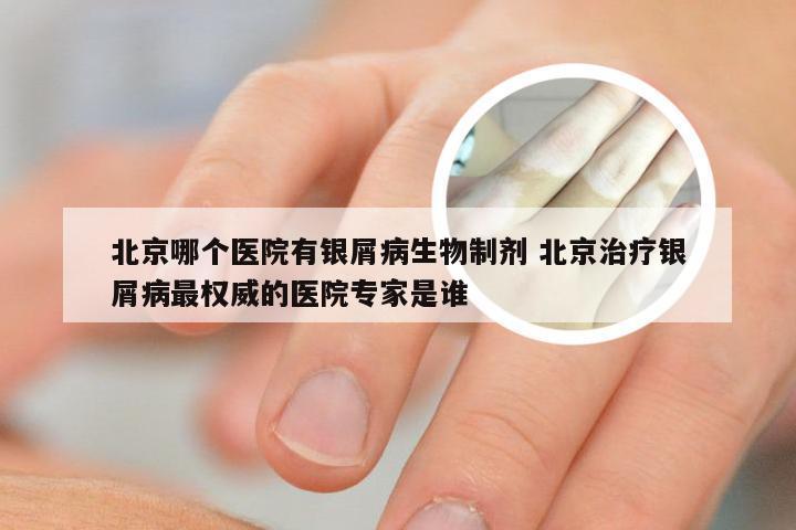 北京哪个医院有银屑病生物制剂 北京治疗银屑病最权威的医院专家是谁