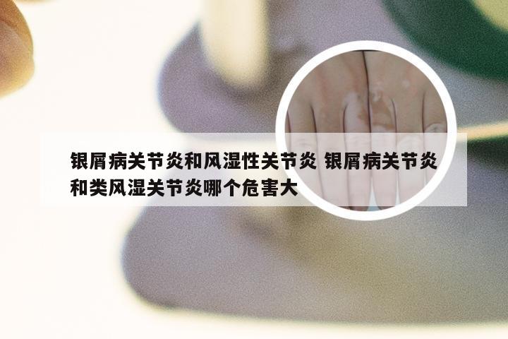 银屑病关节炎和风湿性关节炎 银屑病关节炎和类风湿关节炎哪个危害大