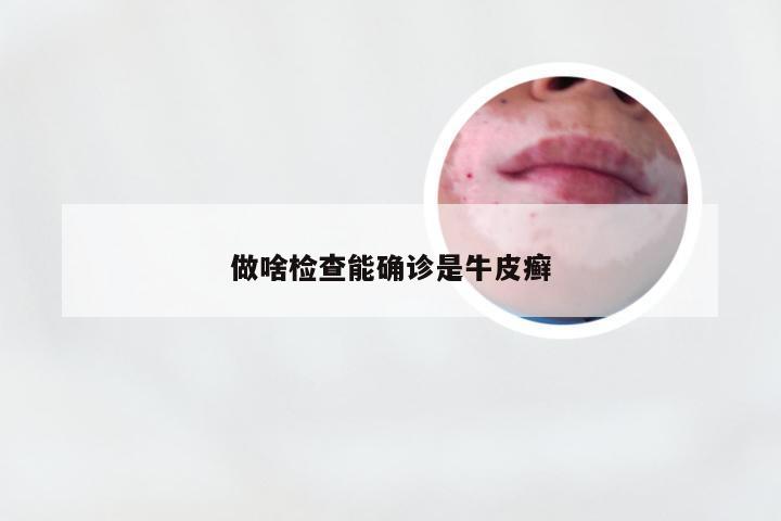 做啥检查能确诊是牛皮癣