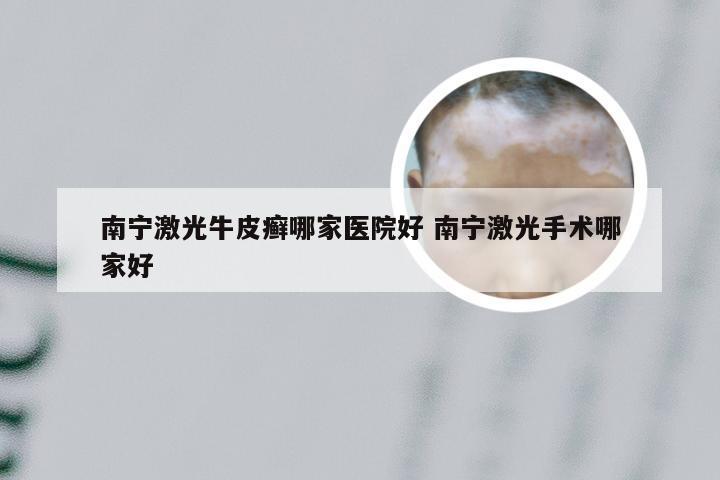 南宁激光牛皮癣哪家医院好 南宁激光手术哪家好