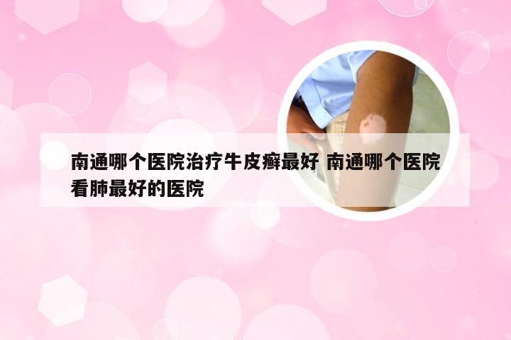 南通哪个医院治疗牛皮癣最好 南通哪个医院看肺最好的医院