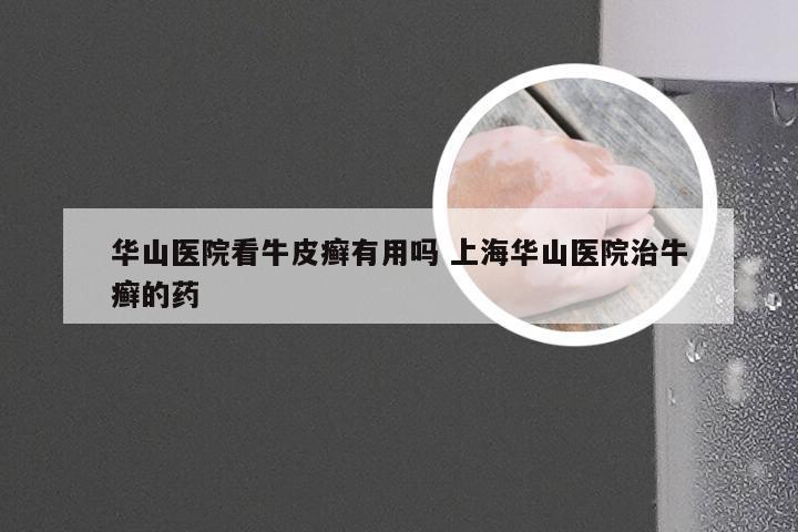 华山医院看牛皮癣有用吗 上海华山医院治牛癣的药