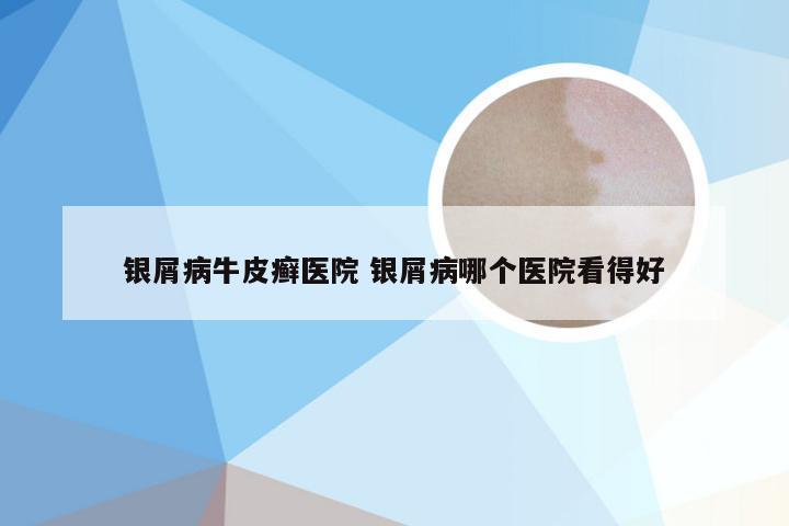 银屑病牛皮癣医院 银屑病哪个医院看得好