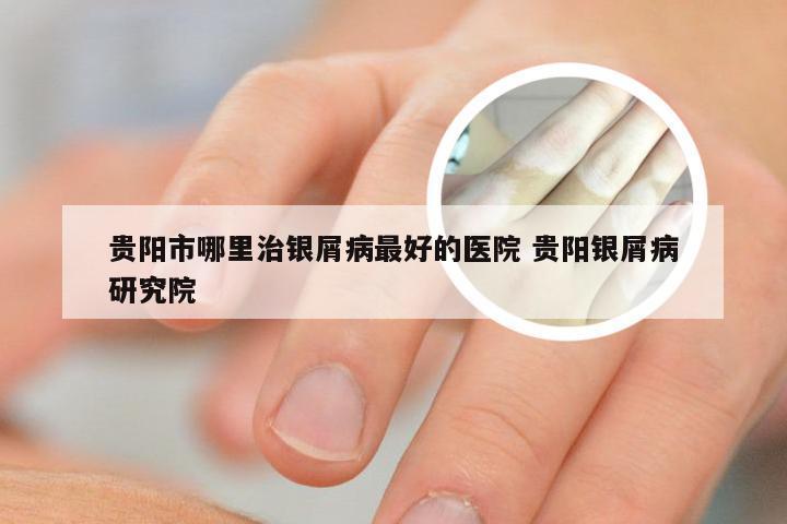 贵阳市哪里治银屑病最好的医院 贵阳银屑病研究院