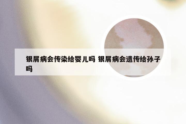 银屑病会传染给婴儿吗 银屑病会遗传给孙子吗