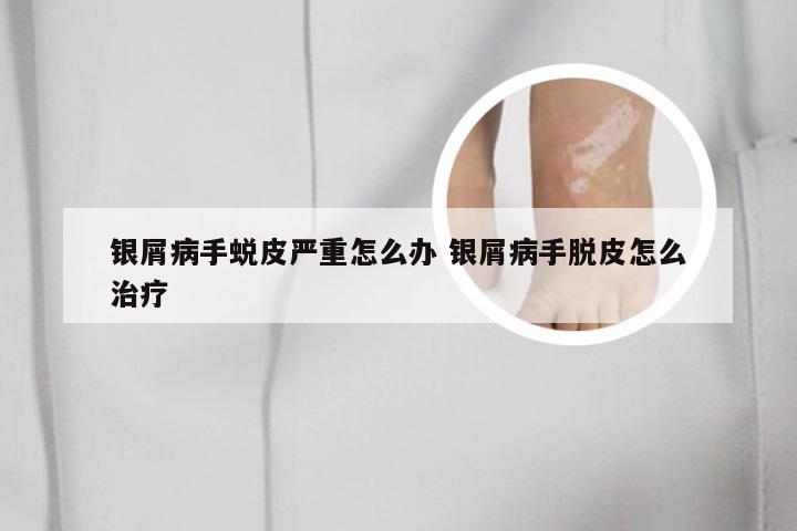 银屑病手蜕皮严重怎么办 银屑病手脱皮怎么治疗