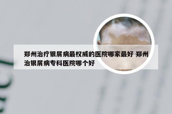 郑州治疗银屑病最权威的医院哪家最好 郑州治银屑病专科医院哪个好