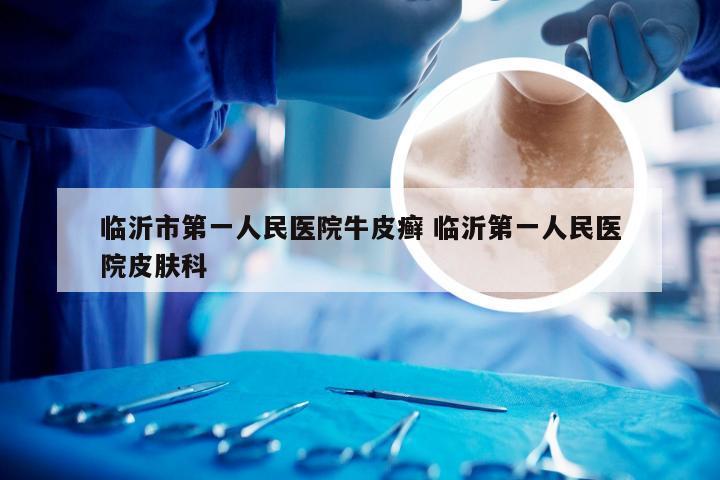 临沂市第一人民医院牛皮癣 临沂第一人民医院皮肤科