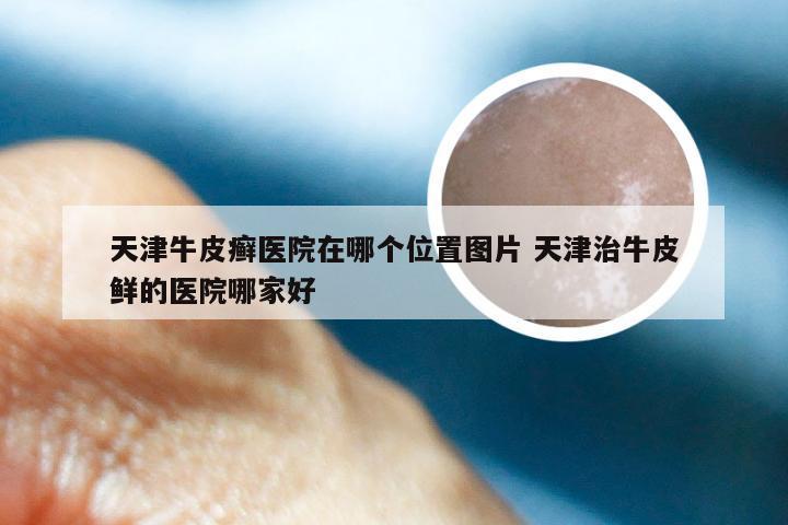 天津牛皮癣医院在哪个位置图片 天津治牛皮鲜的医院哪家好