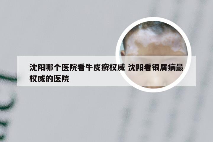 沈阳哪个医院看牛皮癣权威 沈阳看银屑病最权威的医院
