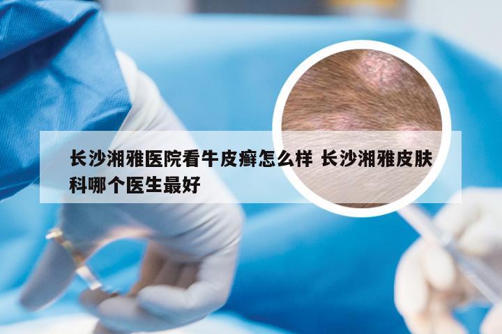 长沙湘雅医院看牛皮癣怎么样 长沙湘雅皮肤科哪个医生最好