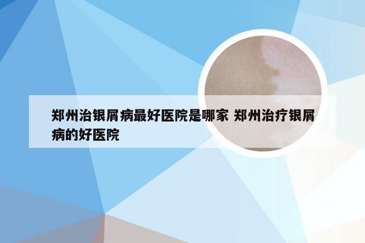 郑州治银屑病最好医院是哪家 郑州治疗银屑病的好医院