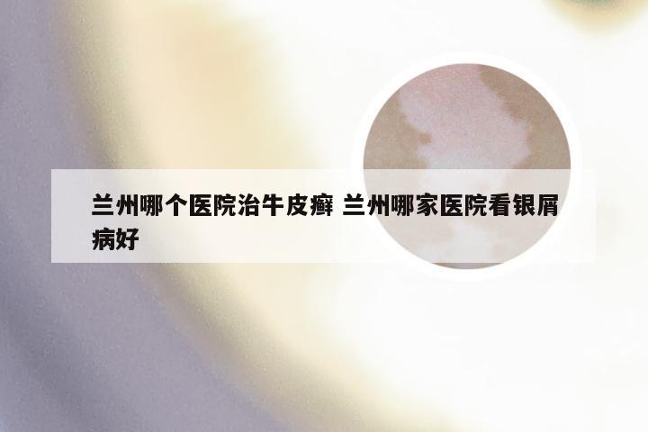 兰州哪个医院治牛皮癣 兰州哪家医院看银屑病好