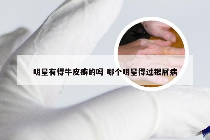 明星有得牛皮癣的吗 哪个明星得过银屑病