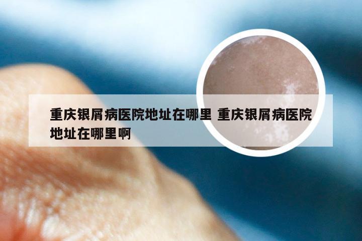 重庆银屑病医院地址在哪里 重庆银屑病医院地址在哪里啊