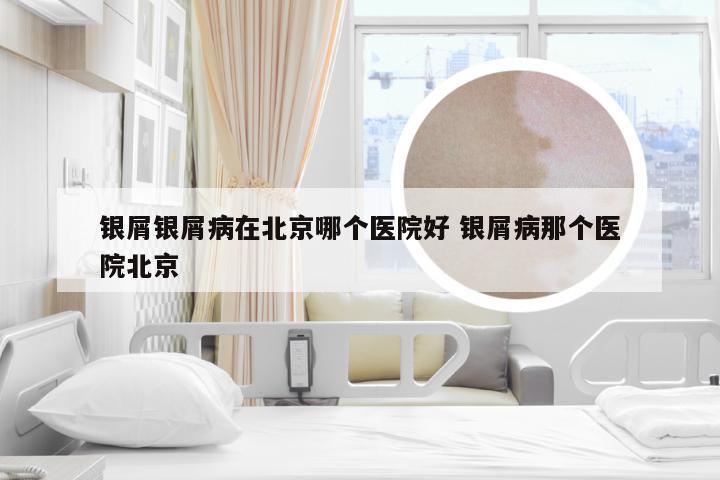 银屑银屑病在北京哪个医院好 银屑病那个医院北京