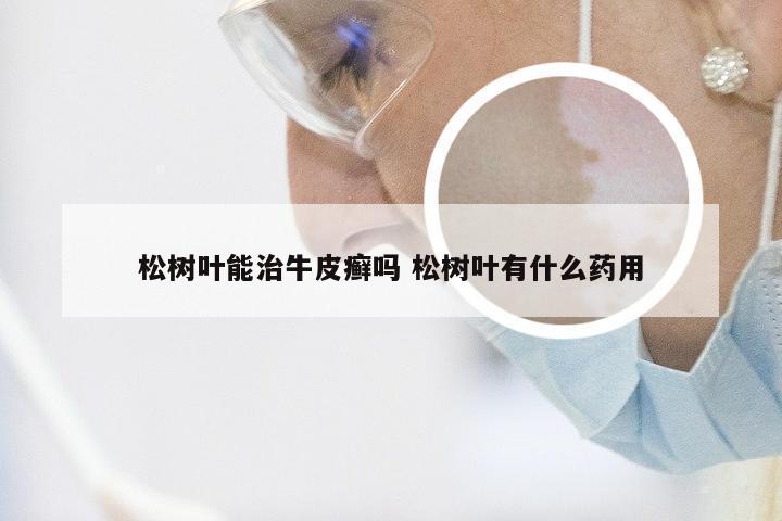 松树叶能治牛皮癣吗 松树叶有什么药用