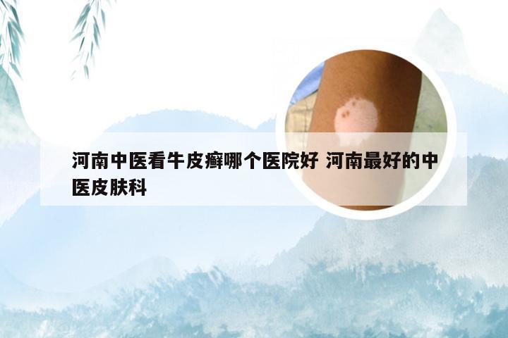 河南中医看牛皮癣哪个医院好 河南最好的中医皮肤科