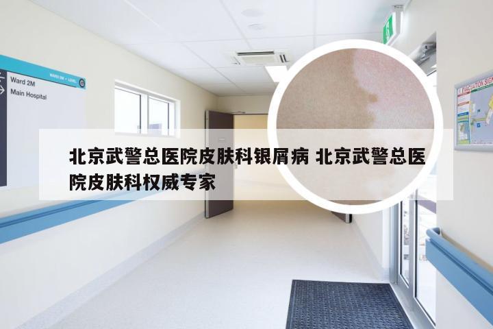 北京武警总医院皮肤科银屑病 北京武警总医院皮肤科权威专家
