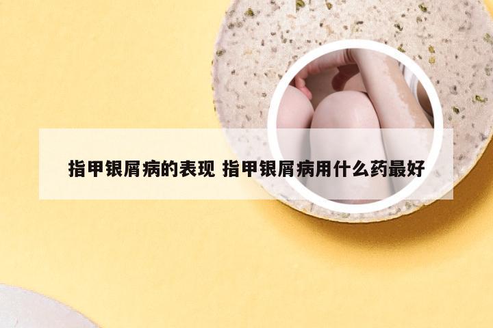 指甲银屑病的表现 指甲银屑病用什么药最好