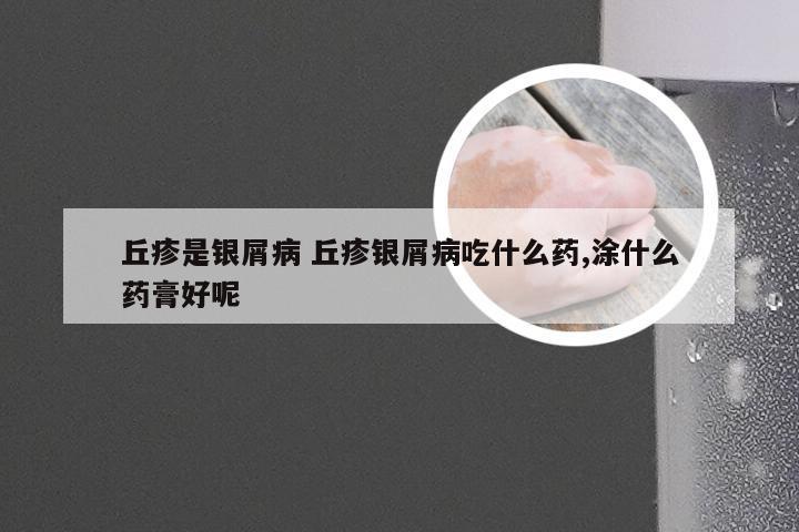 丘疹是银屑病 丘疹银屑病吃什么药,涂什么药膏好呢