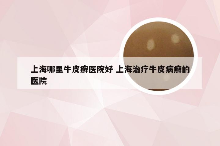 上海哪里牛皮癣医院好 上海治疗牛皮病癣的医院