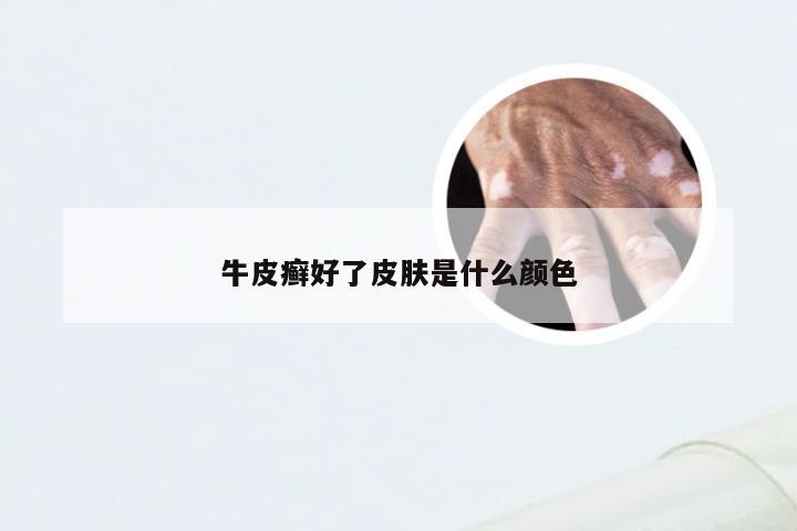 牛皮癣好了皮肤是什么颜色