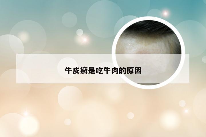 牛皮癣是吃牛肉的原因