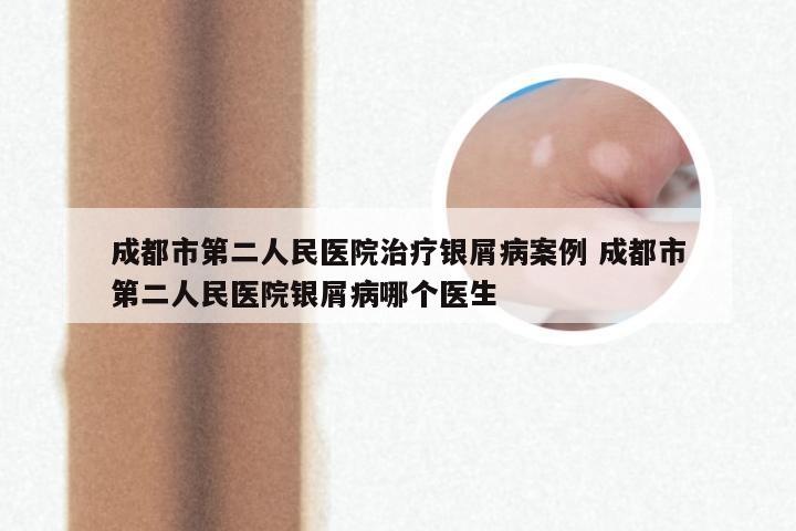 成都市第二人民医院治疗银屑病案例 成都市第二人民医院银屑病哪个医生