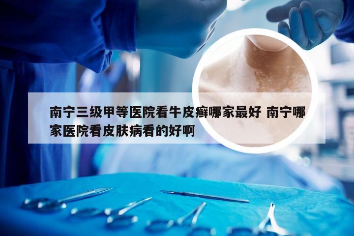 南宁三级甲等医院看牛皮癣哪家最好 南宁哪家医院看皮肤病看的好啊