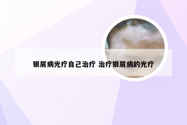 银屑病光疗自己治疗 治疗银屑病的光疗
