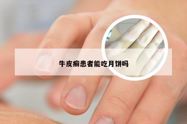牛皮癣患者能吃月饼吗