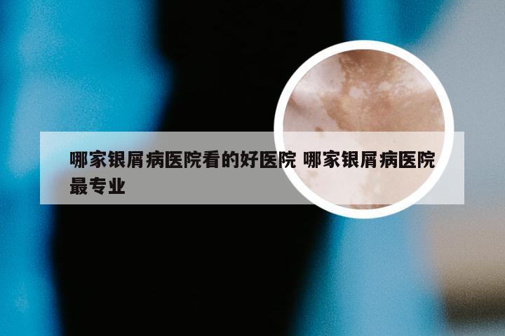 哪家银屑病医院看的好医院 哪家银屑病医院最专业