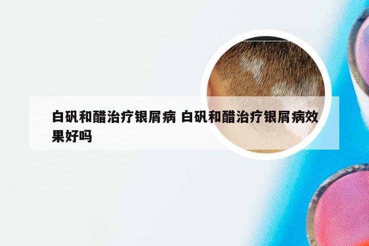 白矾和醋治疗银屑病 白矾和醋治疗银屑病效果好吗