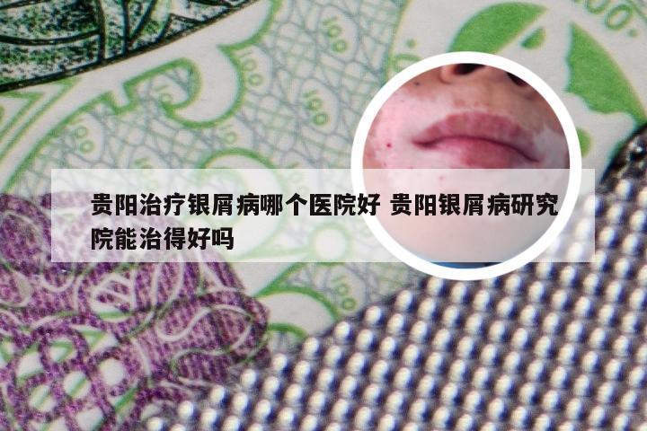贵阳治疗银屑病哪个医院好 贵阳银屑病研究院能治得好吗