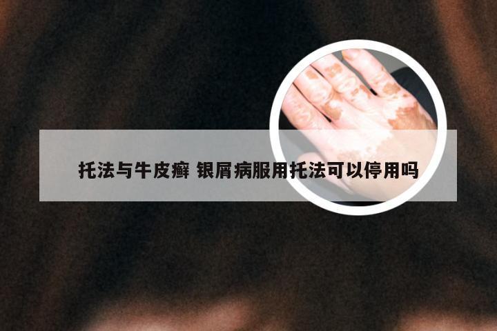 托法与牛皮癣 银屑病服用托法可以停用吗