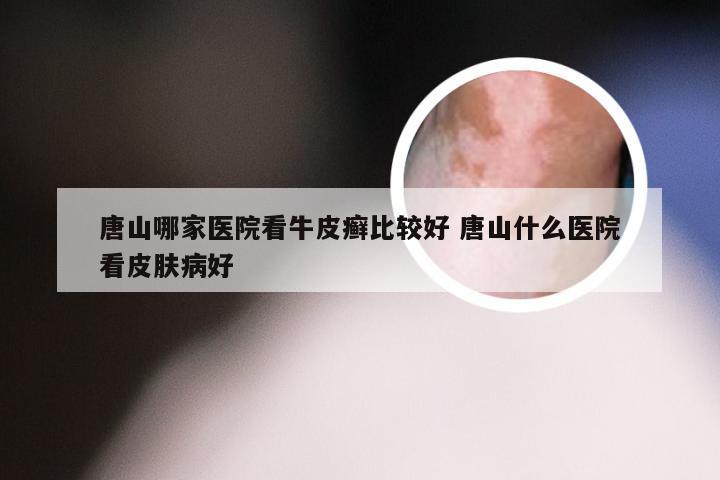 唐山哪家医院看牛皮癣比较好 唐山什么医院看皮肤病好