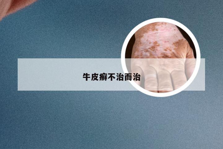 牛皮癣不治而治