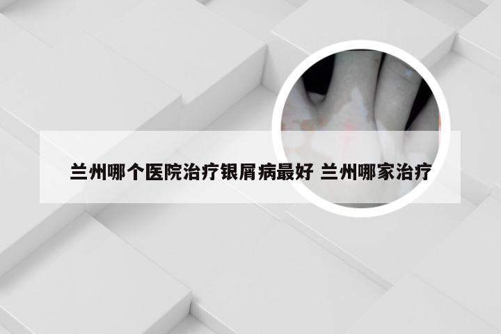 兰州哪个医院治疗银屑病最好 兰州哪家治疗