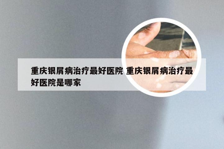 重庆银屑病治疗最好医院 重庆银屑病治疗最好医院是哪家