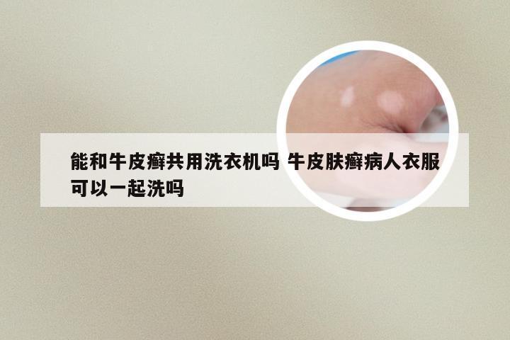 能和牛皮癣共用洗衣机吗 牛皮肤癣病人衣服可以一起洗吗