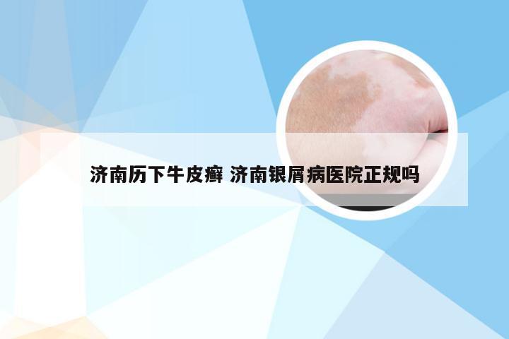 济南历下牛皮癣 济南银屑病医院正规吗