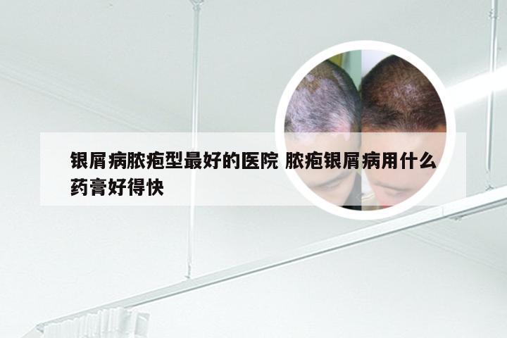 银屑病脓疱型最好的医院 脓疱银屑病用什么药膏好得快
