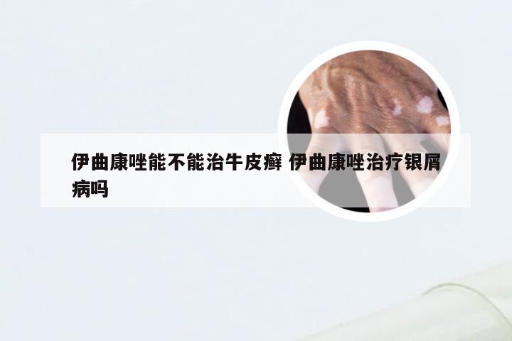 伊曲康唑能不能治牛皮癣 伊曲康唑治疗银屑病吗
