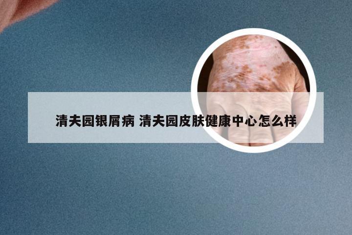 清夫园银屑病 清夫园皮肤健康中心怎么样