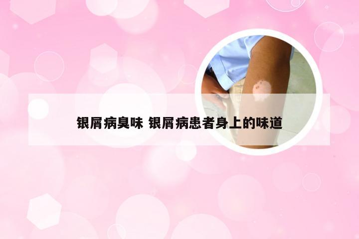 银屑病臭味 银屑病患者身上的味道