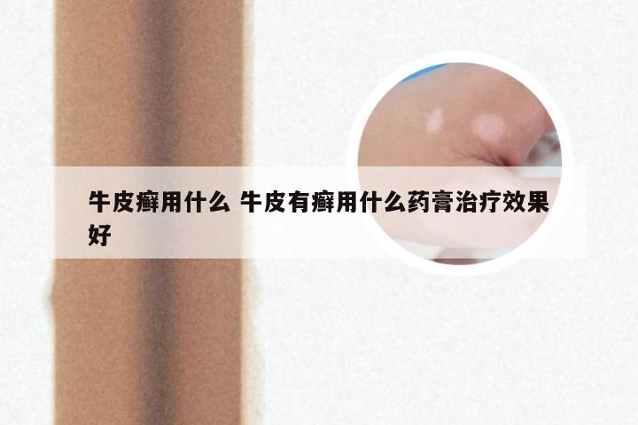 牛皮癣用什么 牛皮有癣用什么药膏治疗效果好
