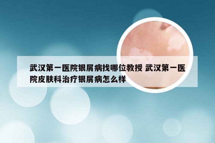 武汉第一医院银屑病找哪位教授 武汉第一医院皮肤科治疗银屑病怎么样