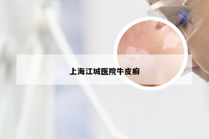 上海江城医院牛皮癣